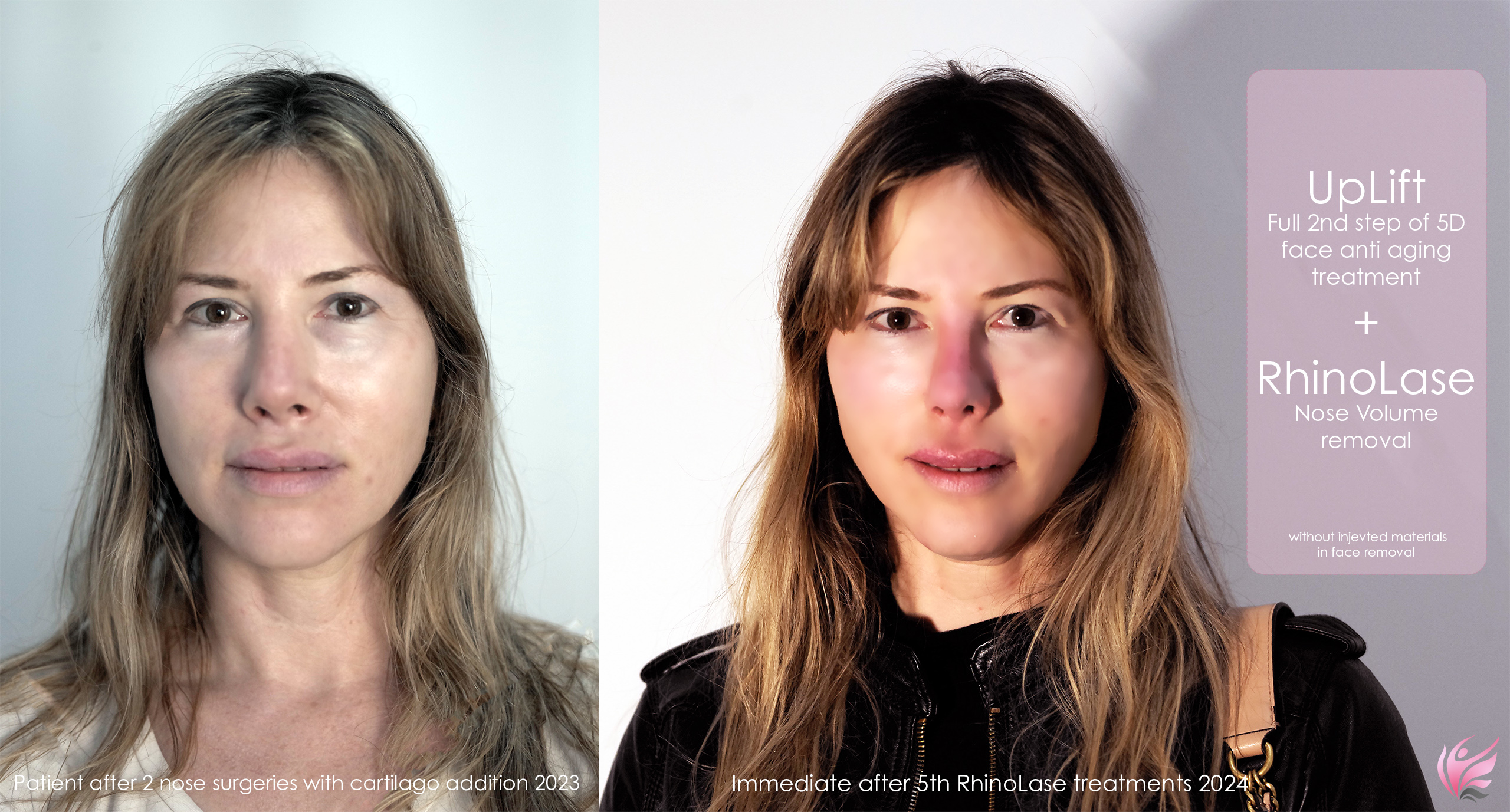 תוצאה לפני ואחרי טיפול פנים עם לייזר פוטונה