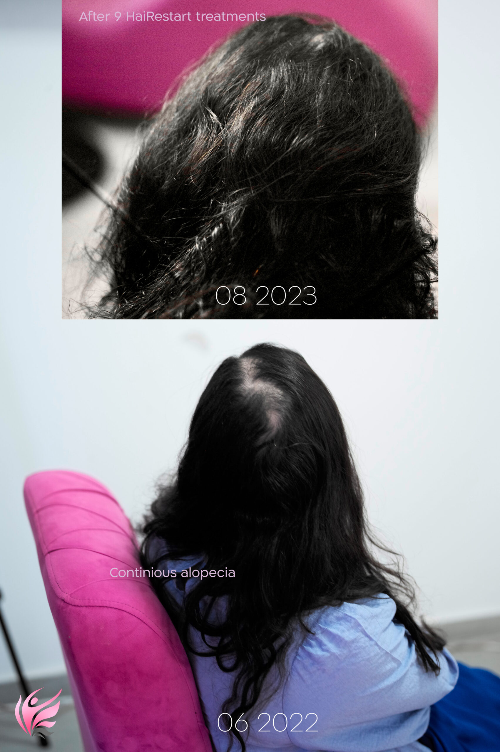 תןוצאות טיפול למניעת התקרחות ומילוי ראש בשיער באמצעות לייזר scaled