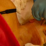 מהלך טיפול קילוף עור בלייזר נרקיסיה
